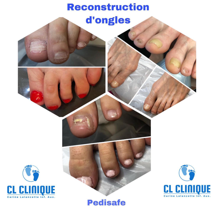 Restructuration d’un ongle technique «PEDISAFE» CL Soins des pieds — free download